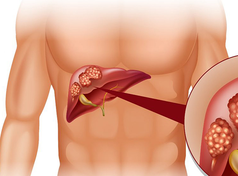 Bile duct cancer