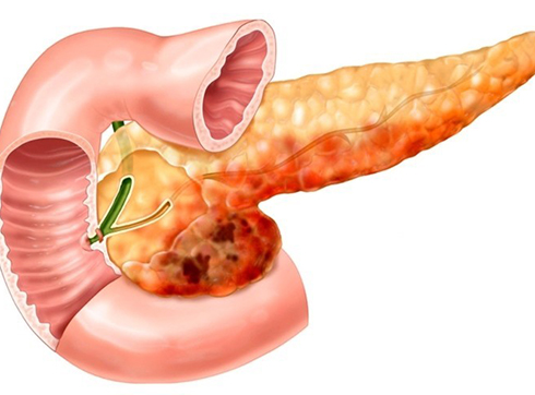 Pancreatitis symptoms, treatment, diagnosis, causes, acute pancreatitis