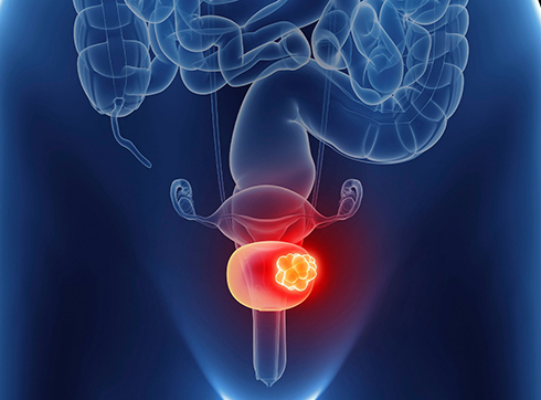 Bladder cancer