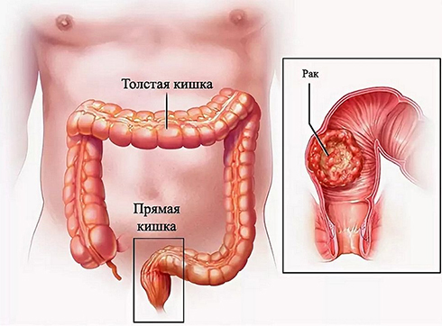 Рак Толстой Кишки Фото