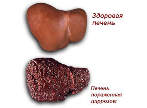 Алкогольная жировая дистрофия печени жирная печень (K70.0)