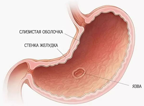 Как Выглядит Язва Фото