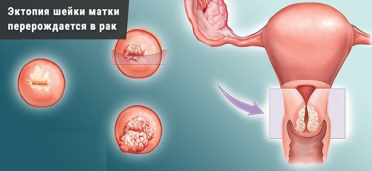 Оргазм после выскабливания