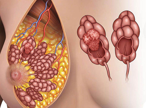 Рак Молочных Желез У Женщин Фото