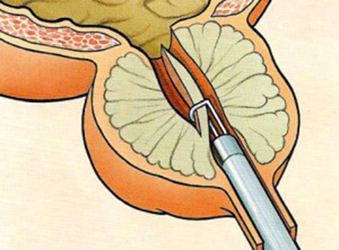 Hol van a kapcsolat a dermatitis és a prostatitisz között?