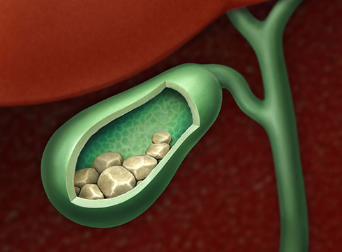 Cholelithiasis